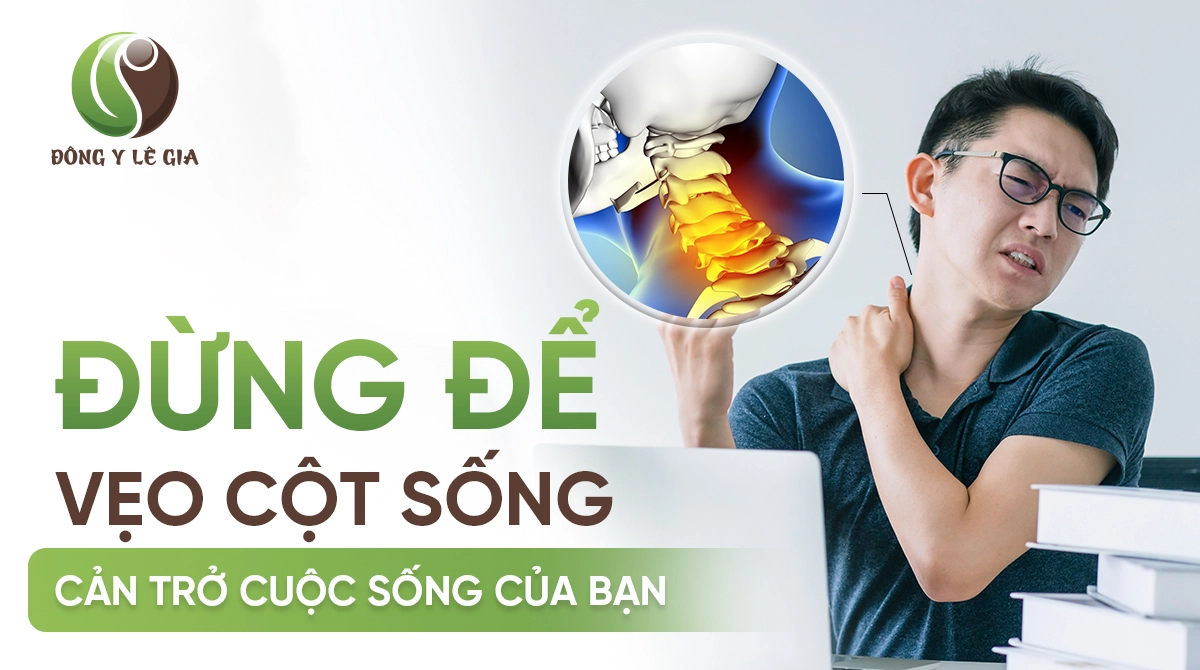 vẹo cột sống