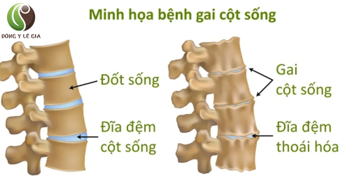 Bị gai cột sống