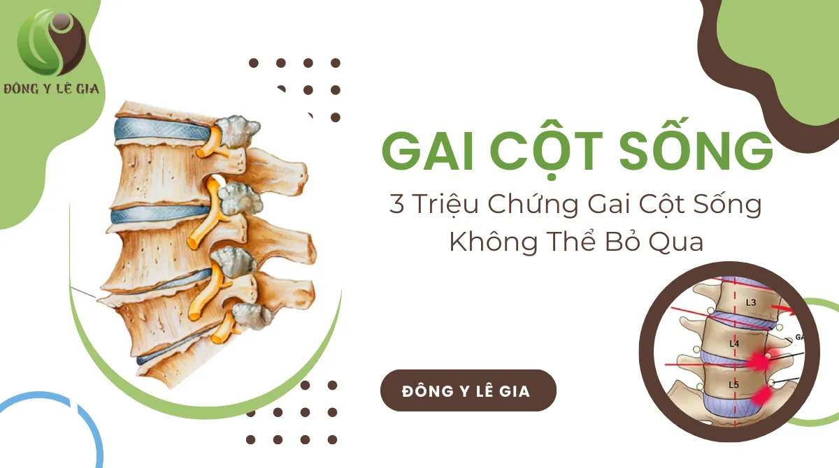 Bị gai cột sống
