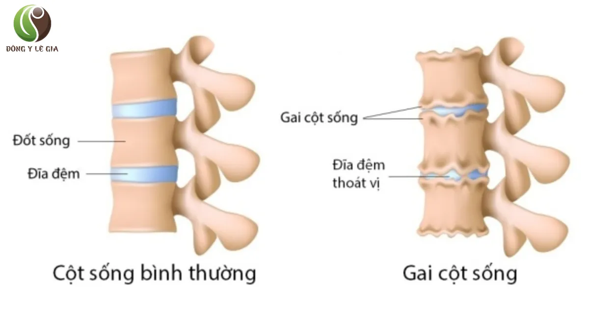 Gai Cột Sống Có Chữa Được Không