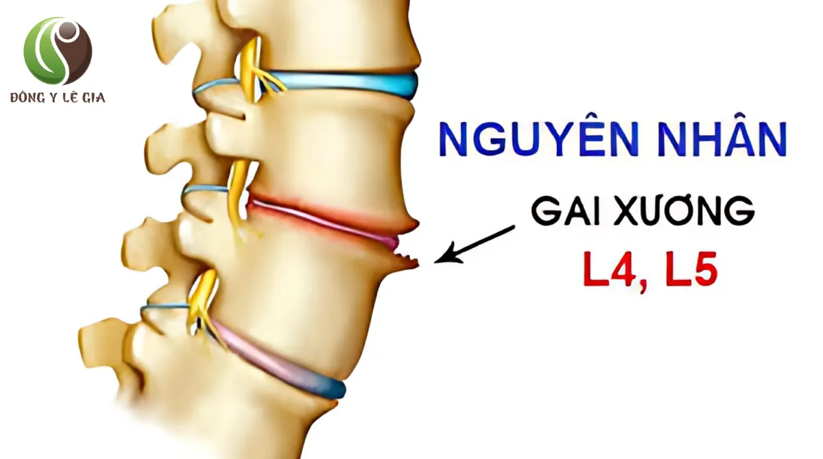 Gai đốt sống lưng
