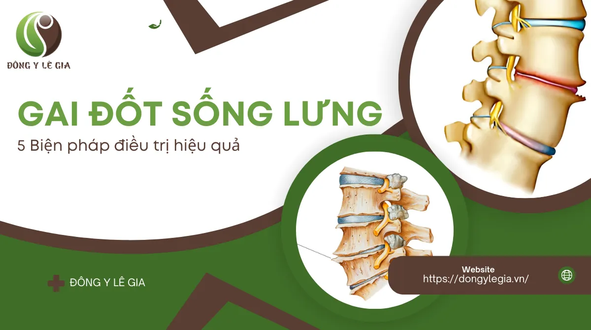 Gai đốt sống lưng