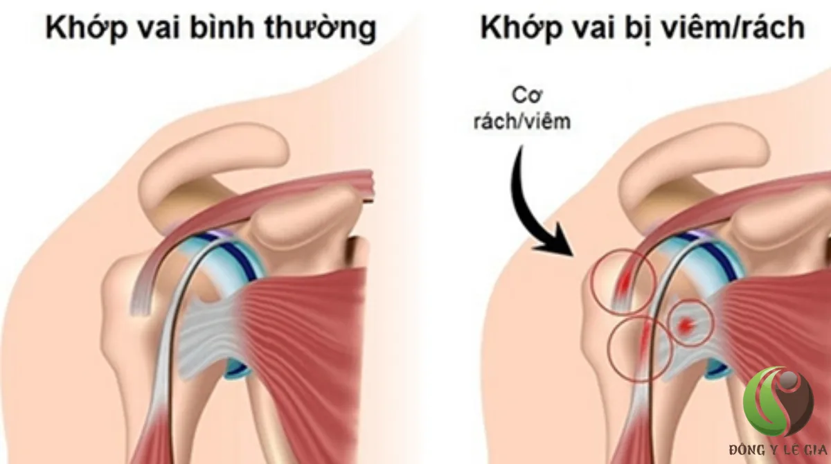 nguyên nhân đau cổ vai gáy
