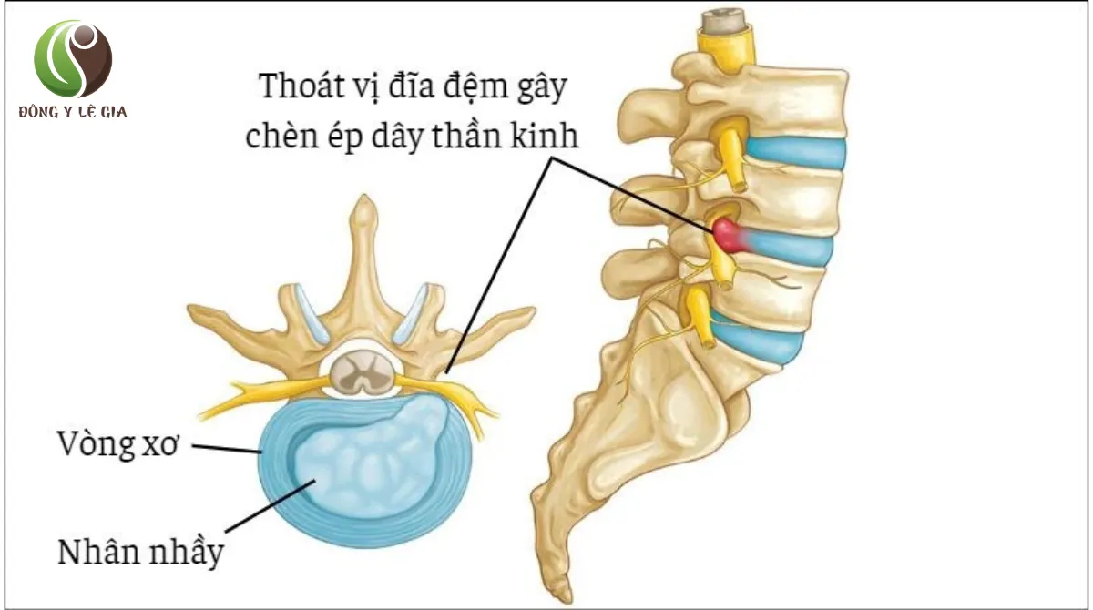 thoái hóa đĩa đệm