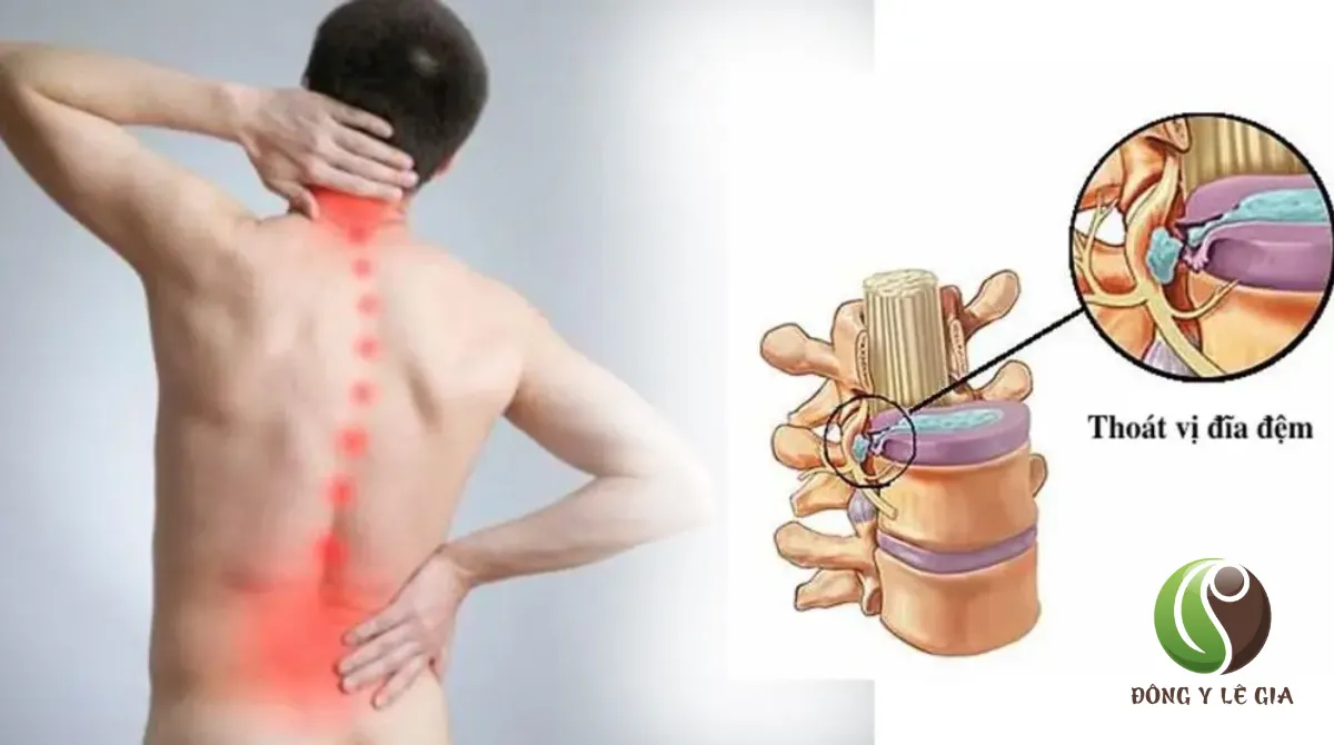 Đau cột sống lưng dưới