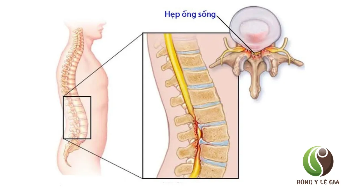 Đau cột sống lưng dưới