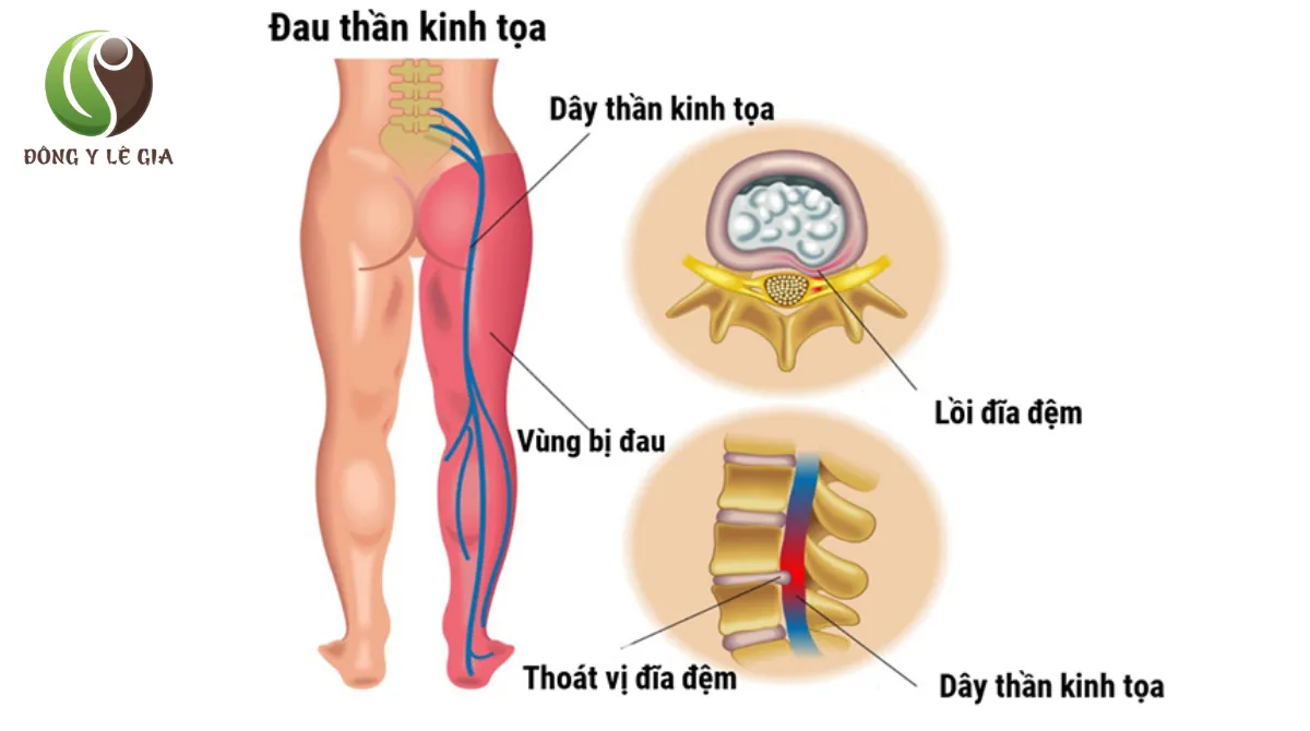  đau thắt lưng cột sống