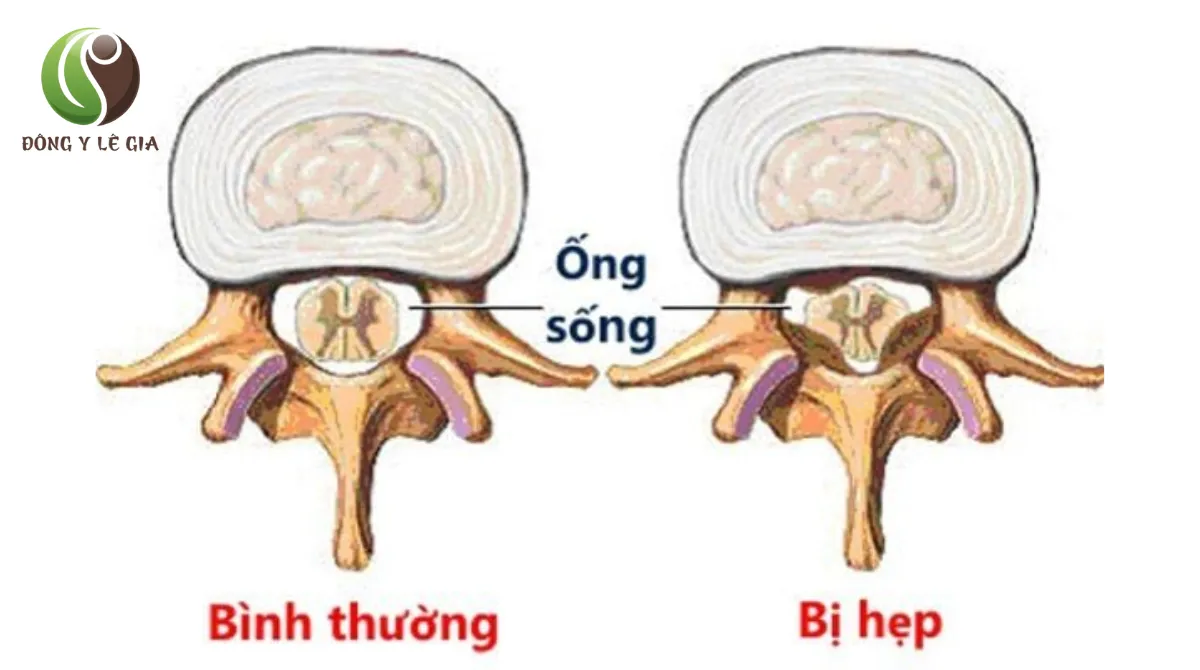  đau thắt lưng cột sống 