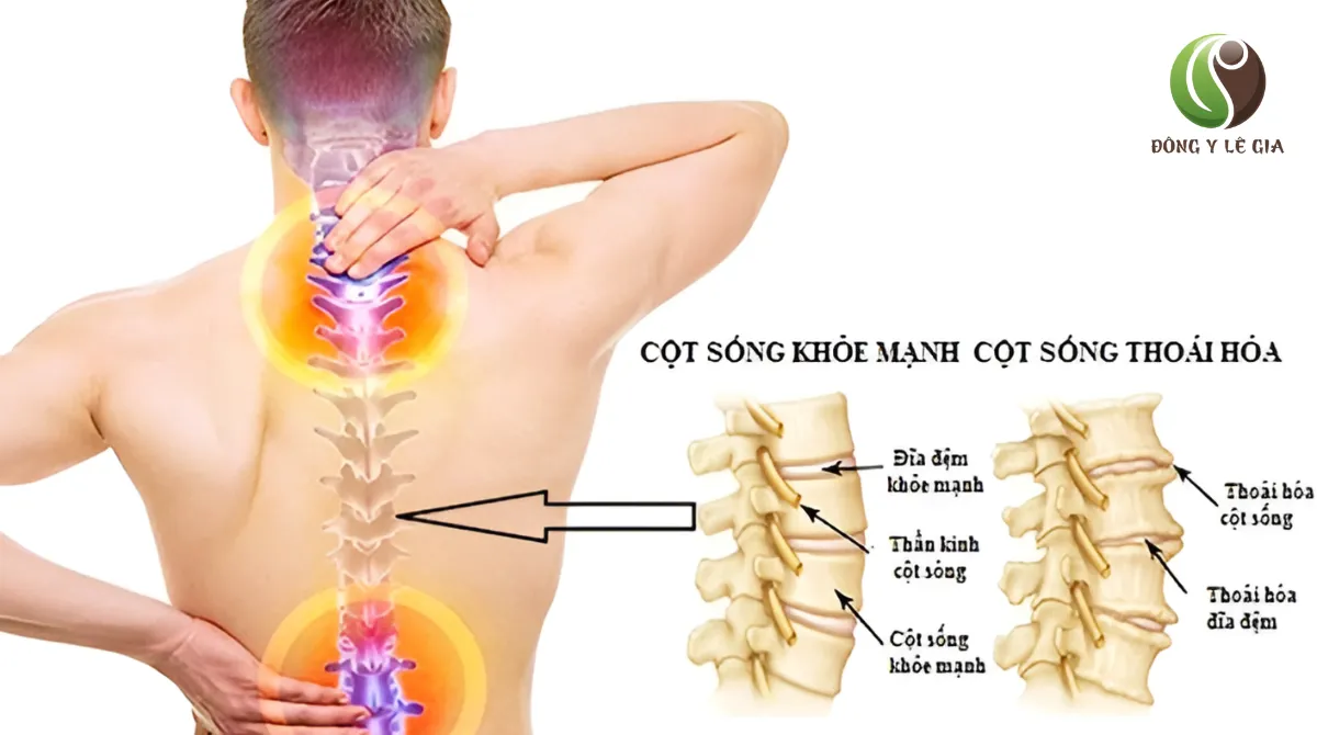 triệu chứng thoái hoá cột sống
