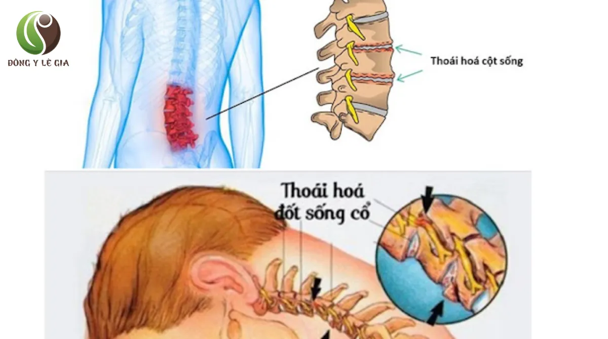 triệu chứng thoái hóa cột sống