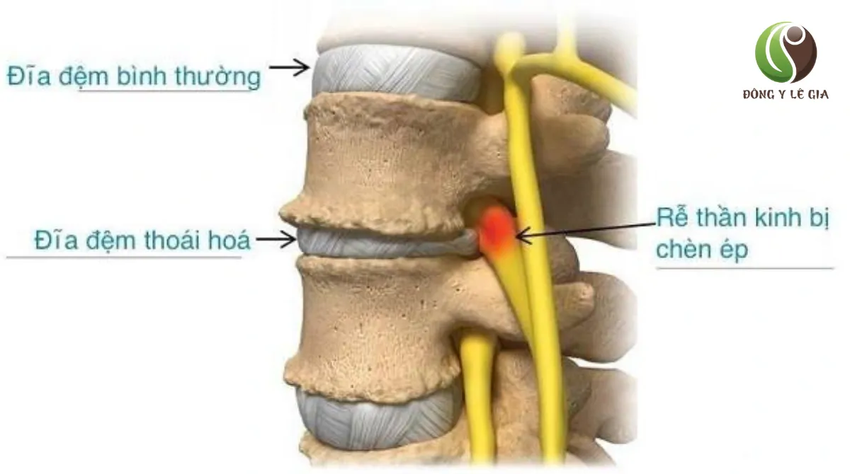 triệu chứng thoái hóa cột sống