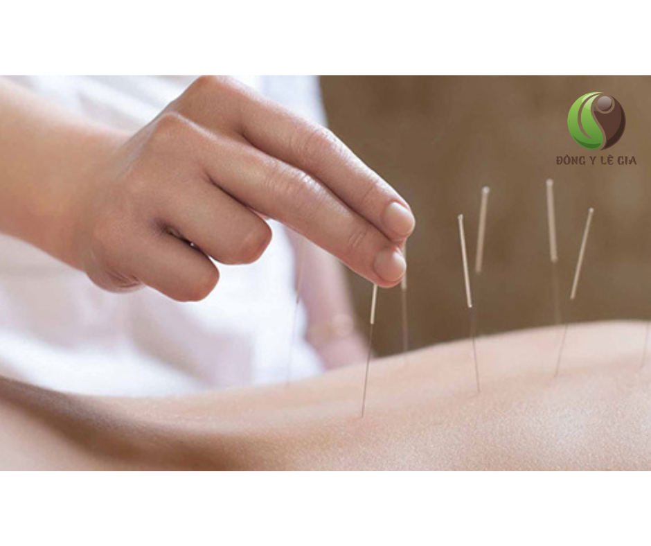 Châm cứu bấm huyệt