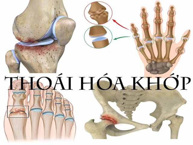 Thoái hóa khớp
