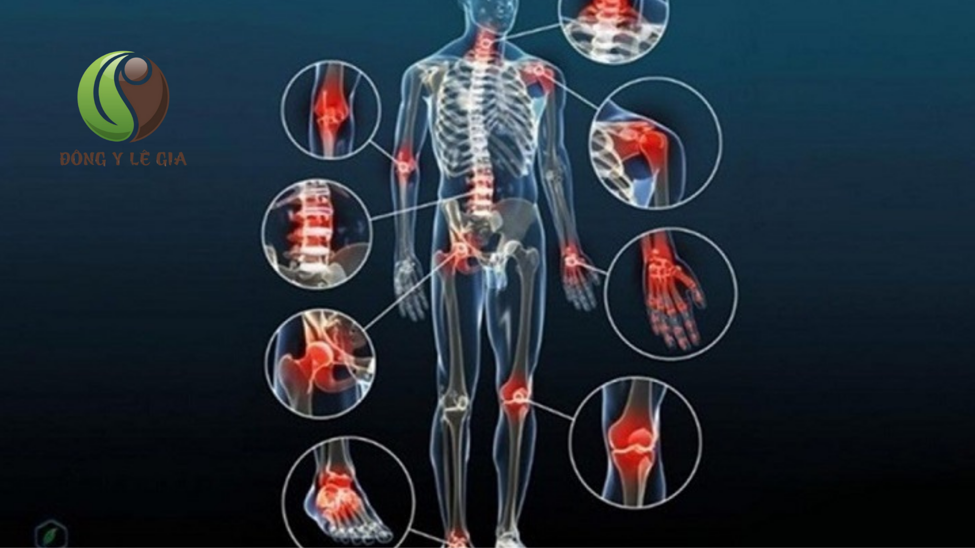 Các vị trí bị thoái hóa