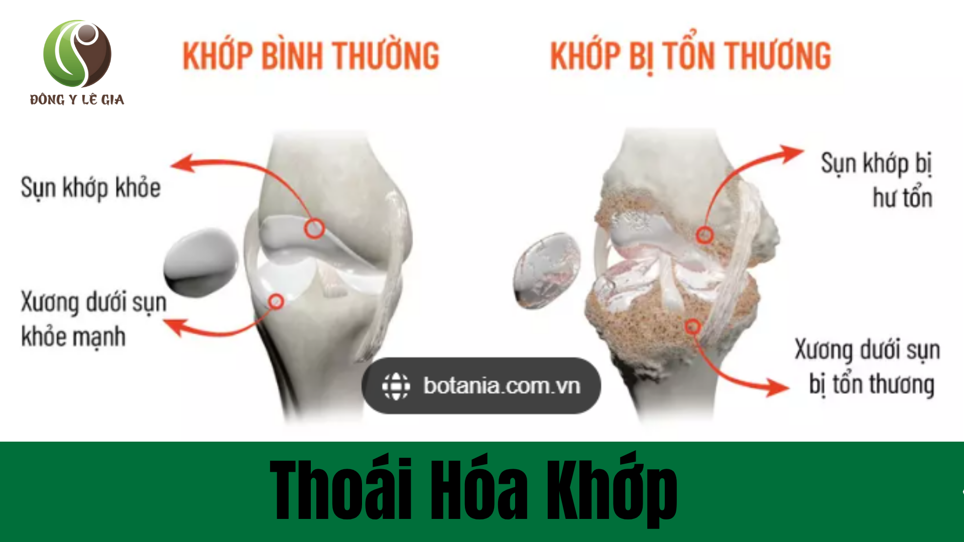 Khớp trước và sau khi bị tổn thương