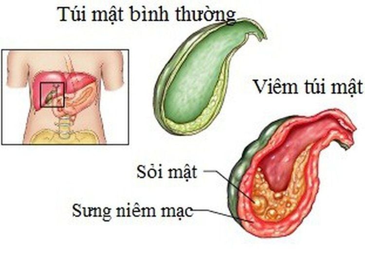 Viêm túi mật có đang hành hạ bạn từng ngày?
