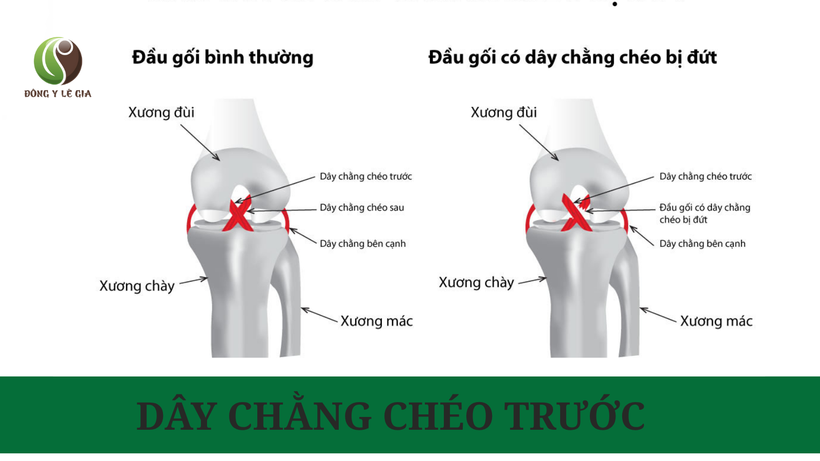 Đứt dây chằng chéo trước là gì?