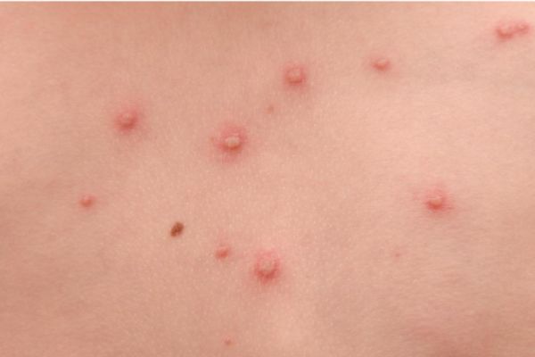Những vết mẩn đỏ do zona thần kinh gây ra